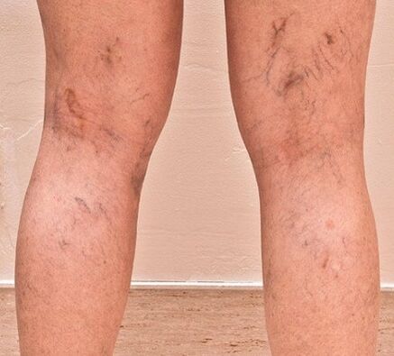 Varicose veins appeared on the legs