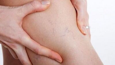 how varicose veins are manifested on the legs