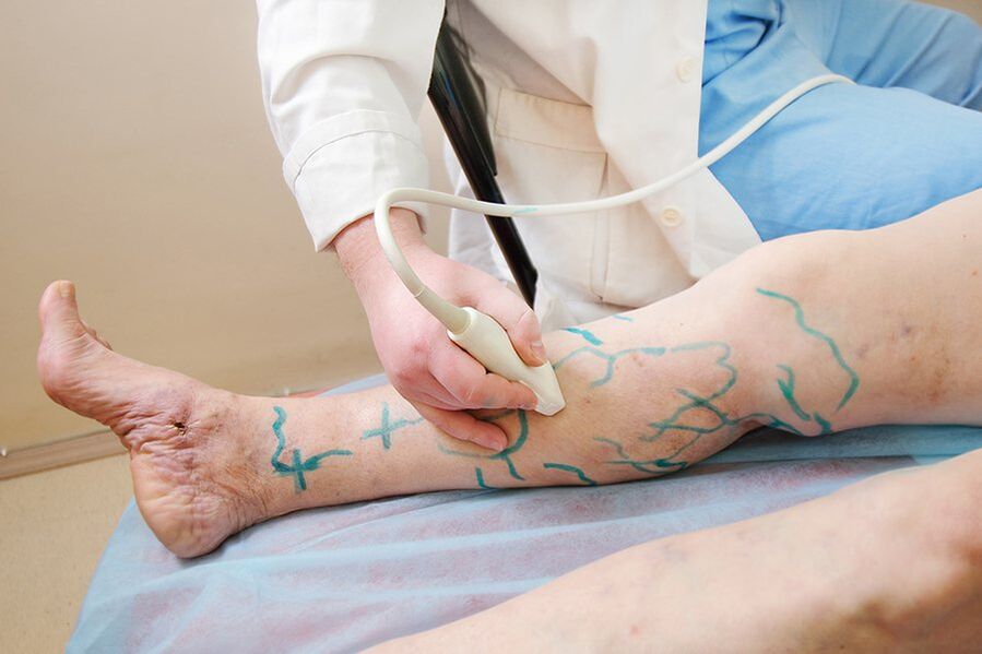 Preparation for miniphlebectomy - marking the perforators of the leg, performing an ultrasound scan