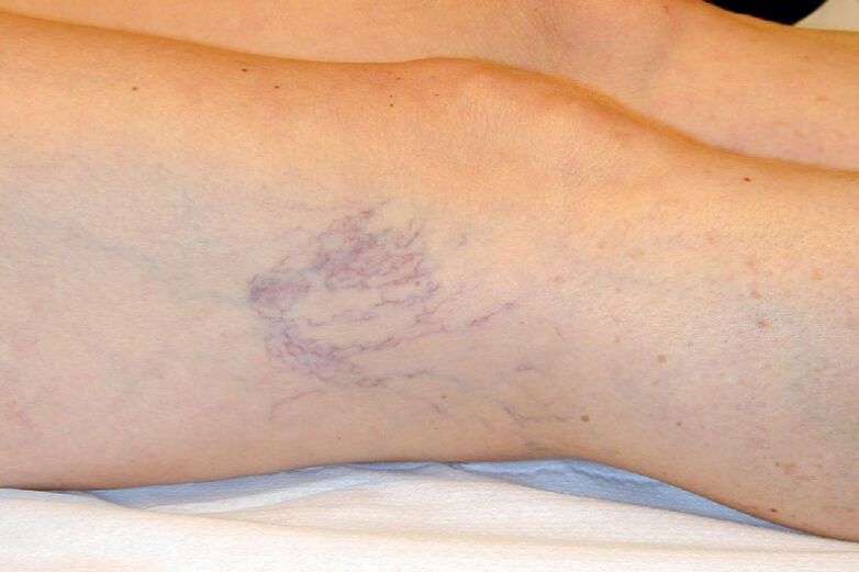 Stage C1 – reticular veins with a diameter of about 1 mm