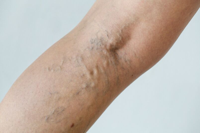 Stage C2 – popliteal varicose veins (Thierry's perforator) and reticular veins